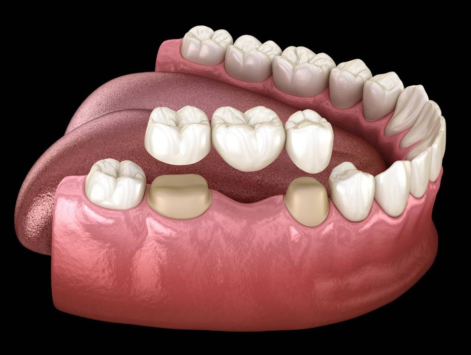 dental bridge