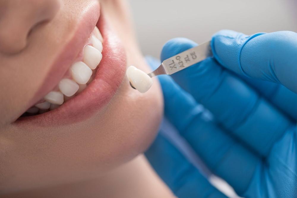 woman getting dental veneers