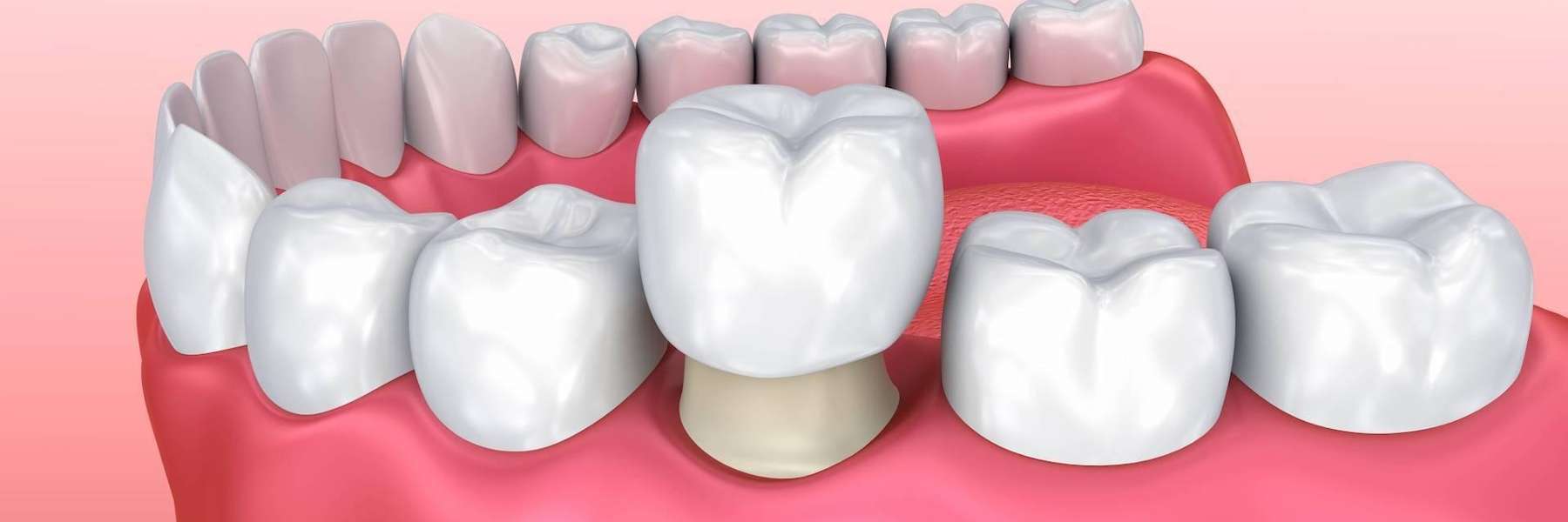White Teeth