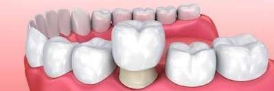 illustration of dental crown going over tooh