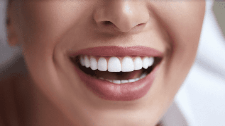 close up of woman's smile after getting veneers in eagle river