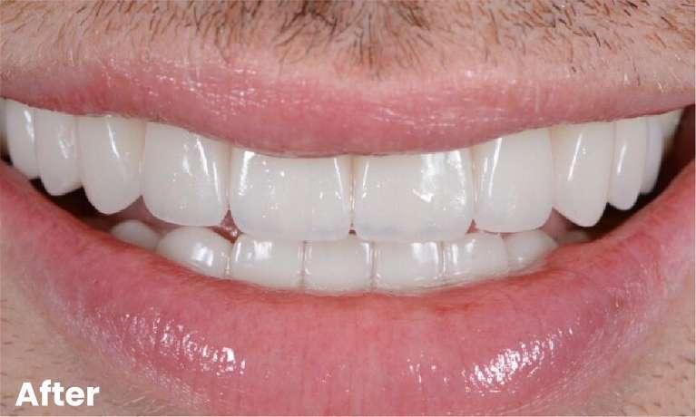 General-Dentistry-for-a-Brighter-Smile-After-Image