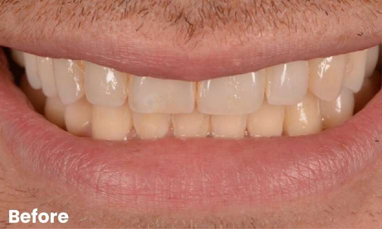 General-Dentistry-for-a-Brighter-Smile-Before-Image